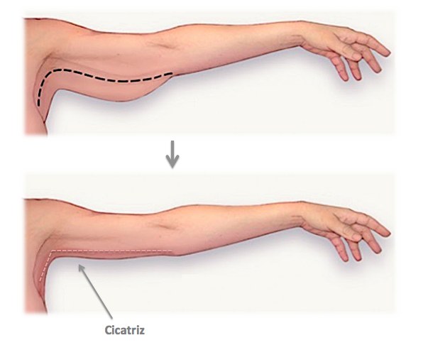 Braquio & Cruroplastia — resultado